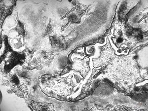 M,53y. | type III membranoproliferative glomerulonephritis